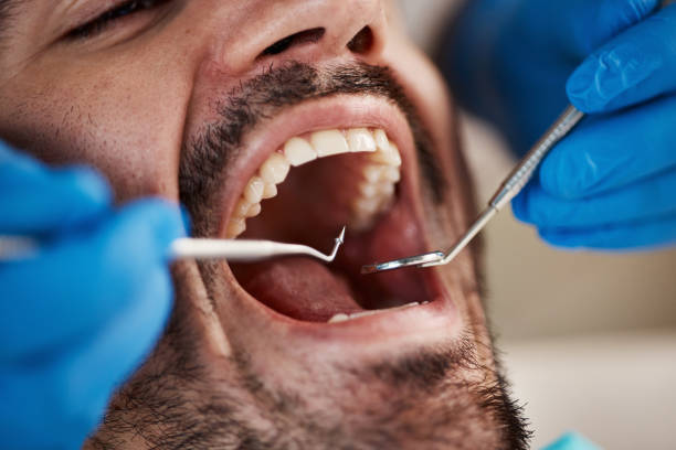Best Wisdom Tooth Removal  in Munroe Falls, OH